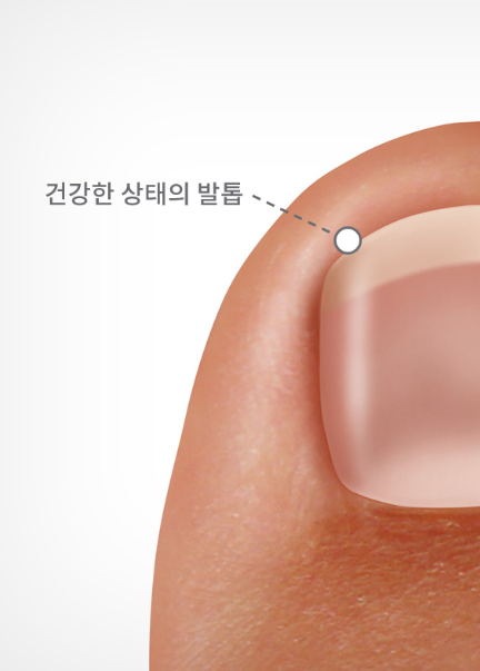 무좀 증상별 무좀약 추천