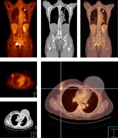 PET CT 검사