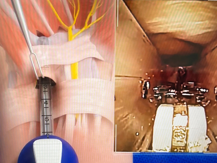 손목터널 증후군 내시경 치료