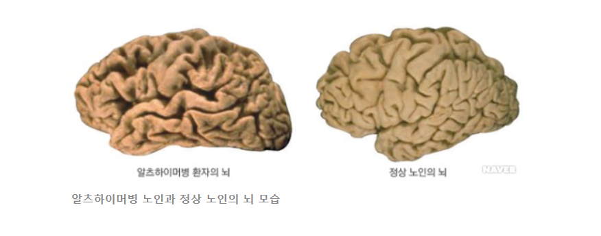 알츠하이머 초기증상 4가지와 대처방법 알아보기