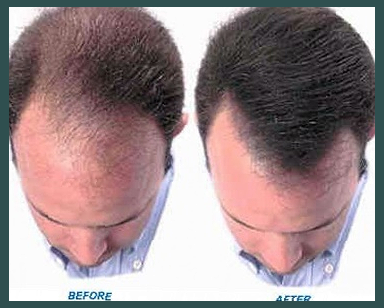 커클랜드 미녹시딜 직구