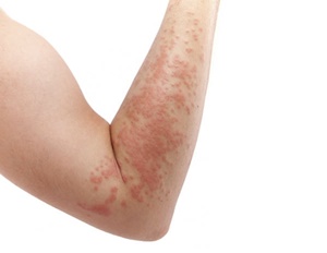 알루미늄 알레르기