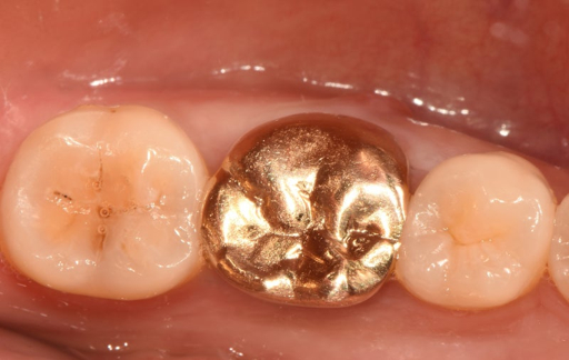 금니 팔기 전 시세 확인하기