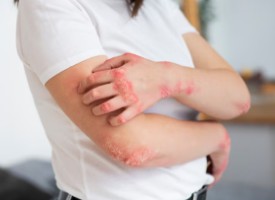 콜린성-두드러기-3