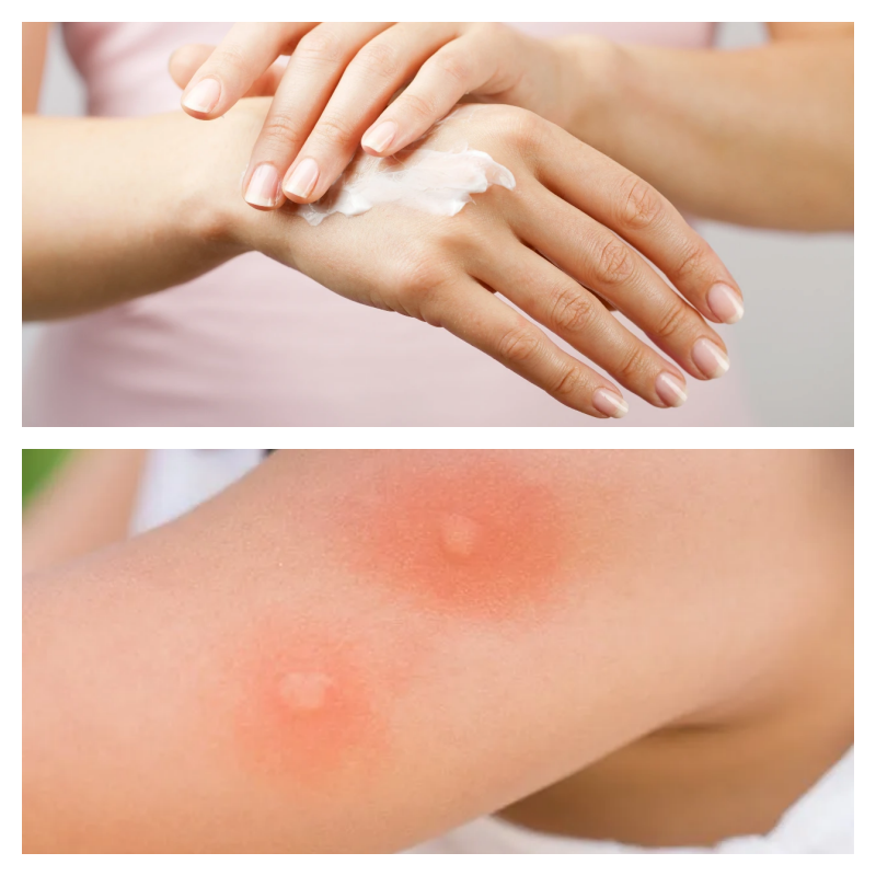 모기 물렸을 때