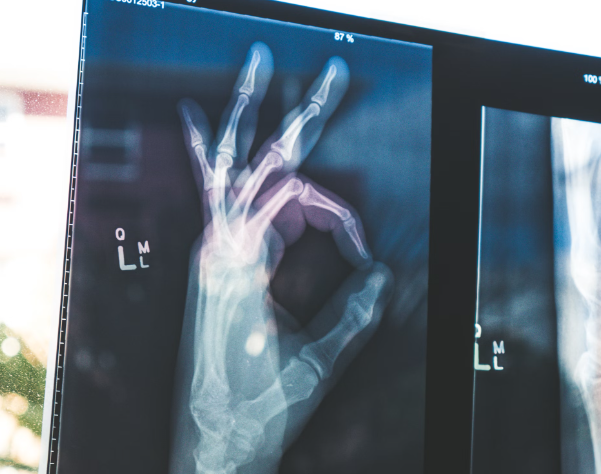 산양유 단백질 효능 : 뼈건강