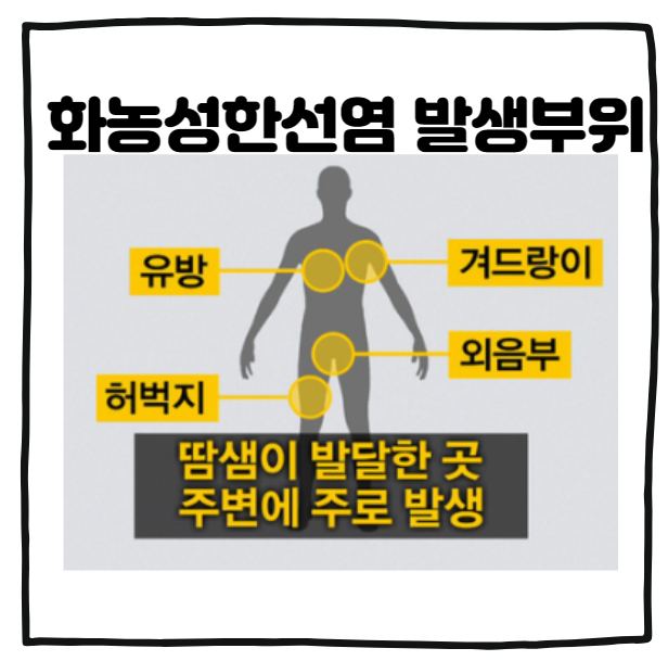 화농성한선염 발생부위