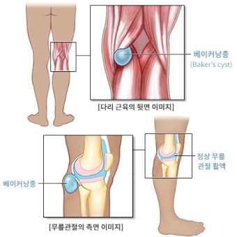 베이커낭종 3