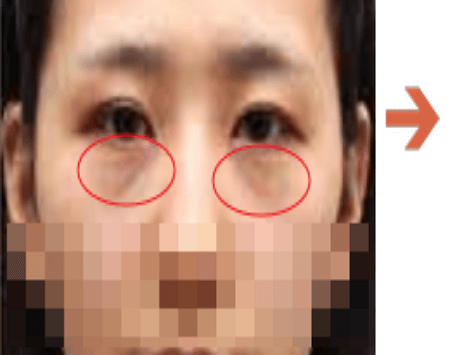 아이캐번 실리프팅 시술 전 사진 예시