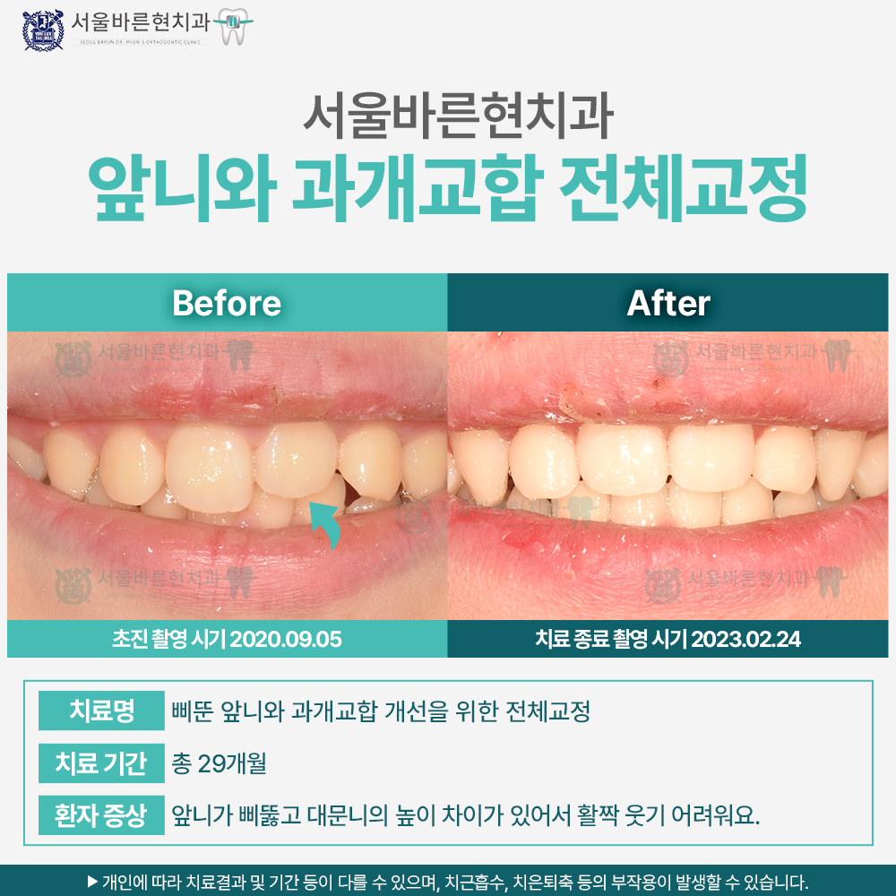 해운대치아교정