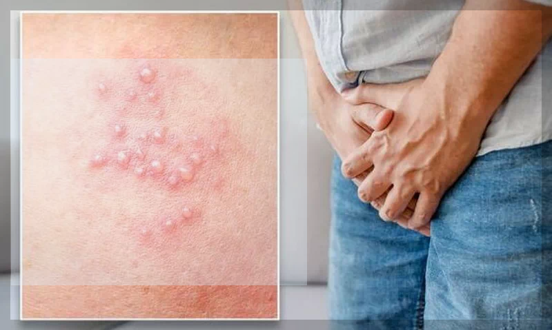 사타구니 대상포진