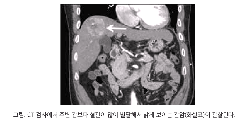 비만으로 간암까지? 술 안 마셔도 위험합니다