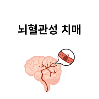 혈관성치매 원인 증상 치료법과 예방 생활습관_16