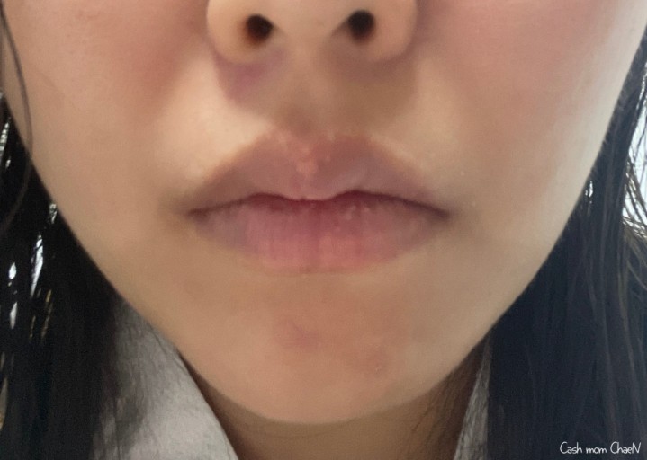 입술이 붓는 이유