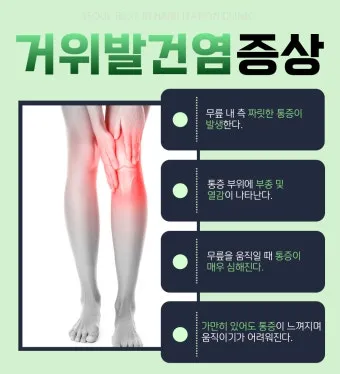 거위발 건염 원인과 증상 무릎 안쪽 통증 치료법 정리_9