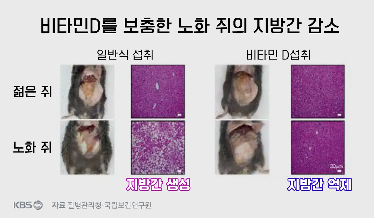 비타민D와 지방간에 대한 연구 사진