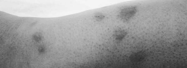 빈대 물린자국: 특징