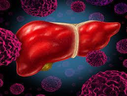 간이 나쁘면 나타나는 증상 간경화 초기증상&amp;#44; 치료법