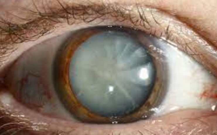 백내장 증상 6가지