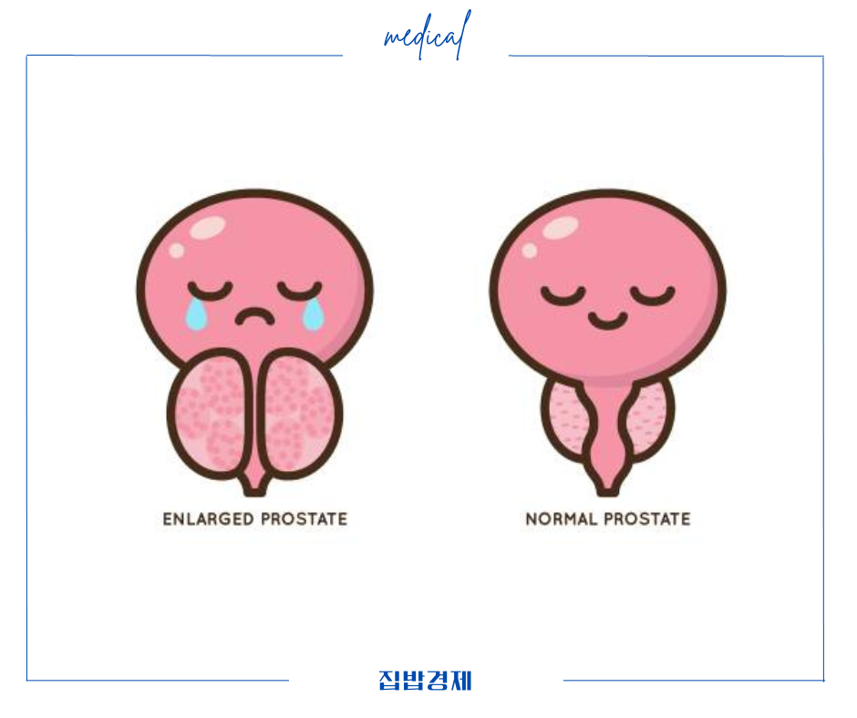 전립선비대증