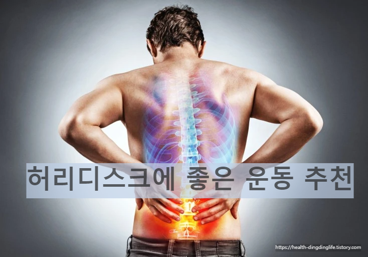 허리디스크 이미지 입니다.