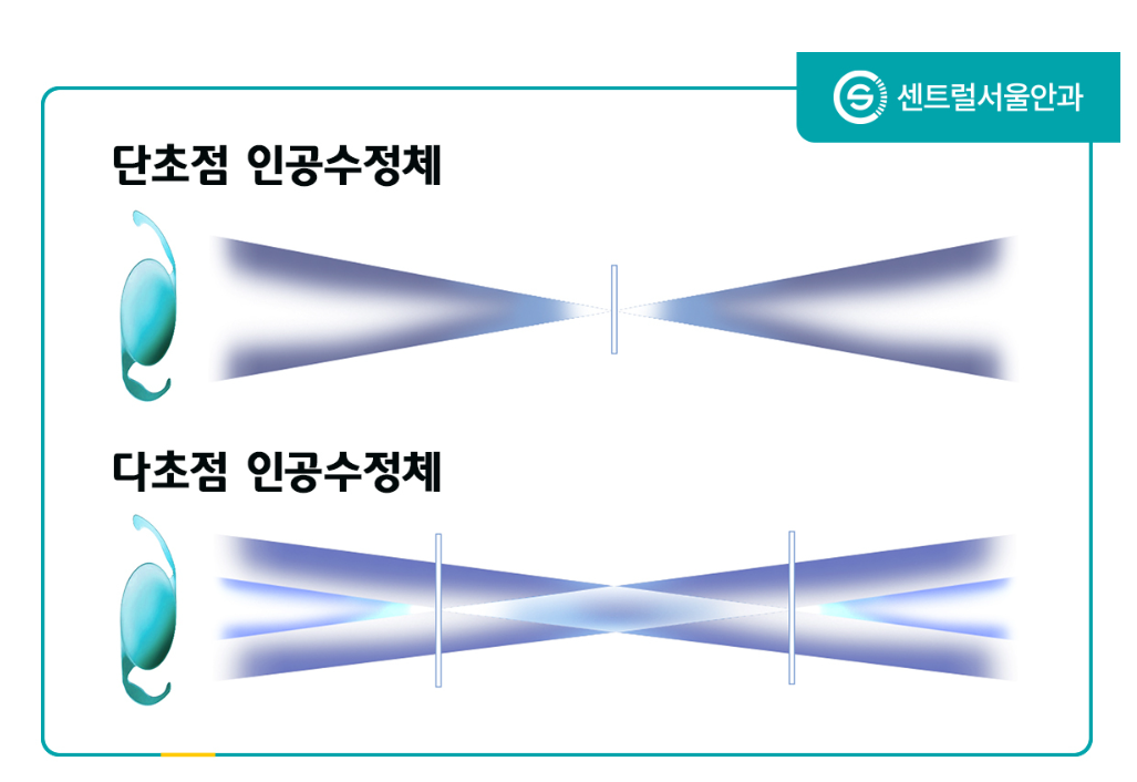 일반 백내장 수술, 노안 백내장 수술 차이점