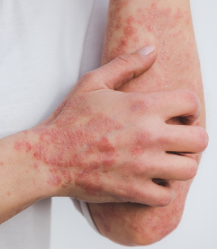 피부 붉은반점 6