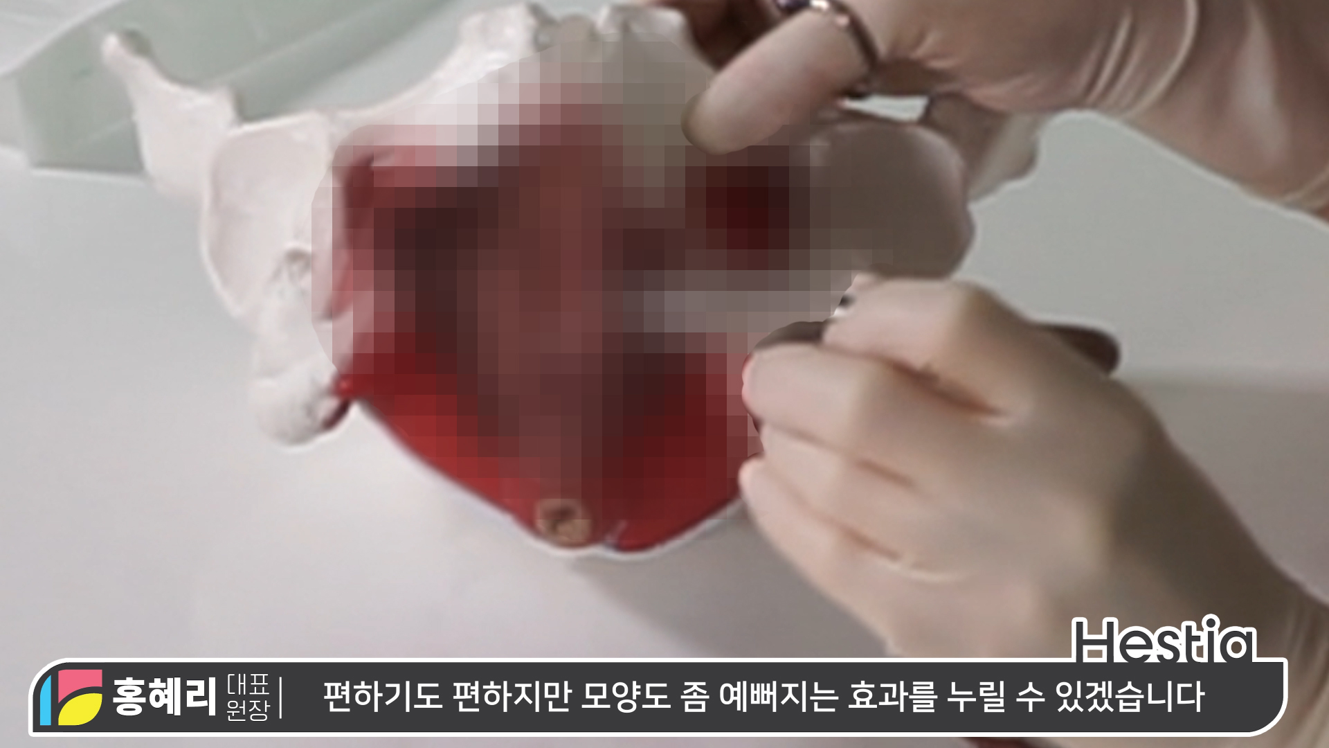 소음순성형수술 과정 대.공.개 ※수술 시물레이션 포함!