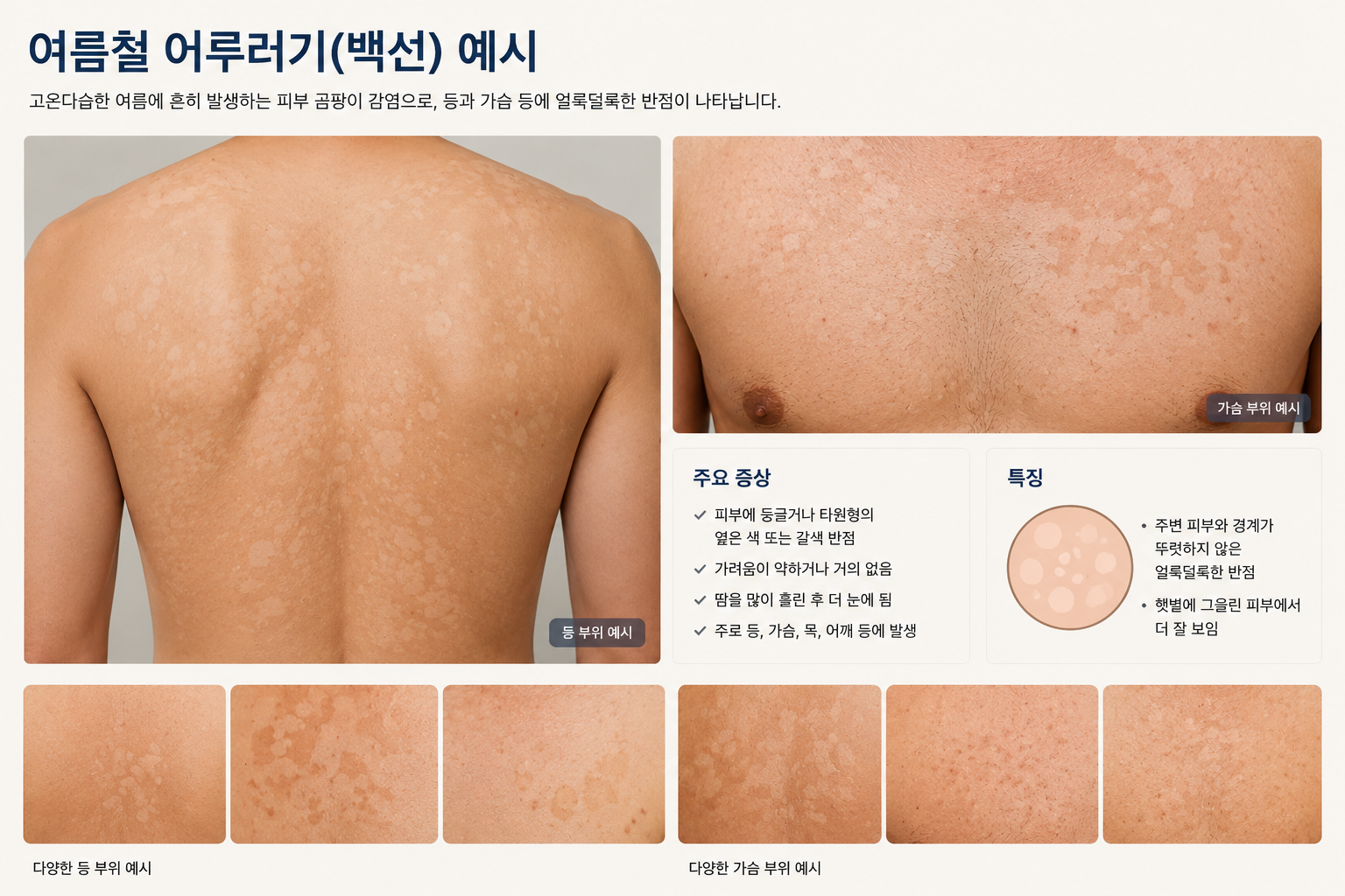 여름철 등과 가슴에 생긴 어루러기 얼룩 반점 예시