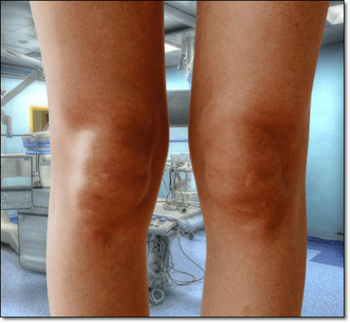 무릎 관절염 환자