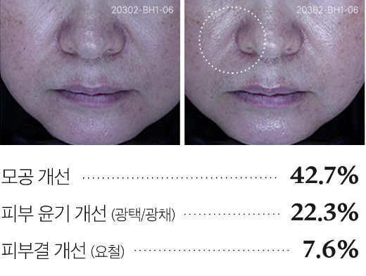 4주 사용으로 인한 피부 탄력 변화