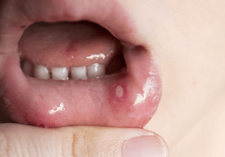 아프타성 구내염