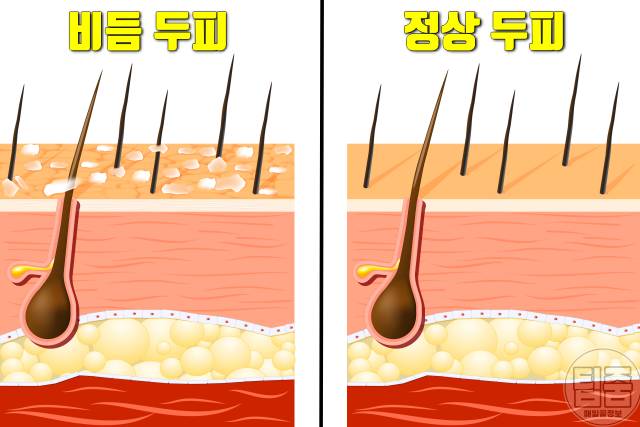 따듯한 물 6잔의 기적,따듯한 물 효능,비듬