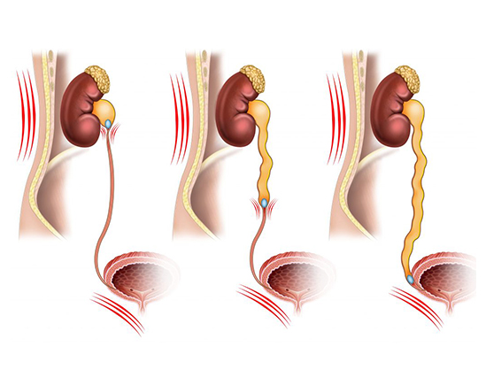 요로결석 쇄석술 치료