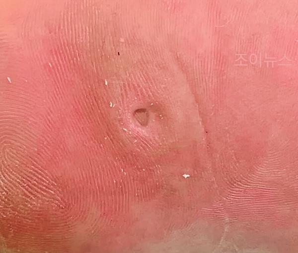 티눈 전염성?