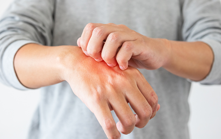 주부습진의 증상