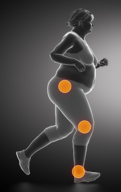 비만 환자가 평소에 많이 호소하는 관절부분의 통증을 형상화한 사진