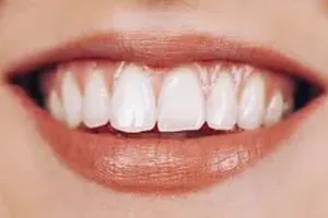 치아