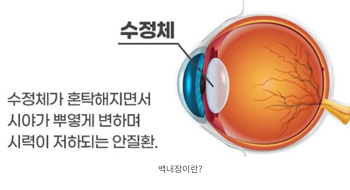 백내장