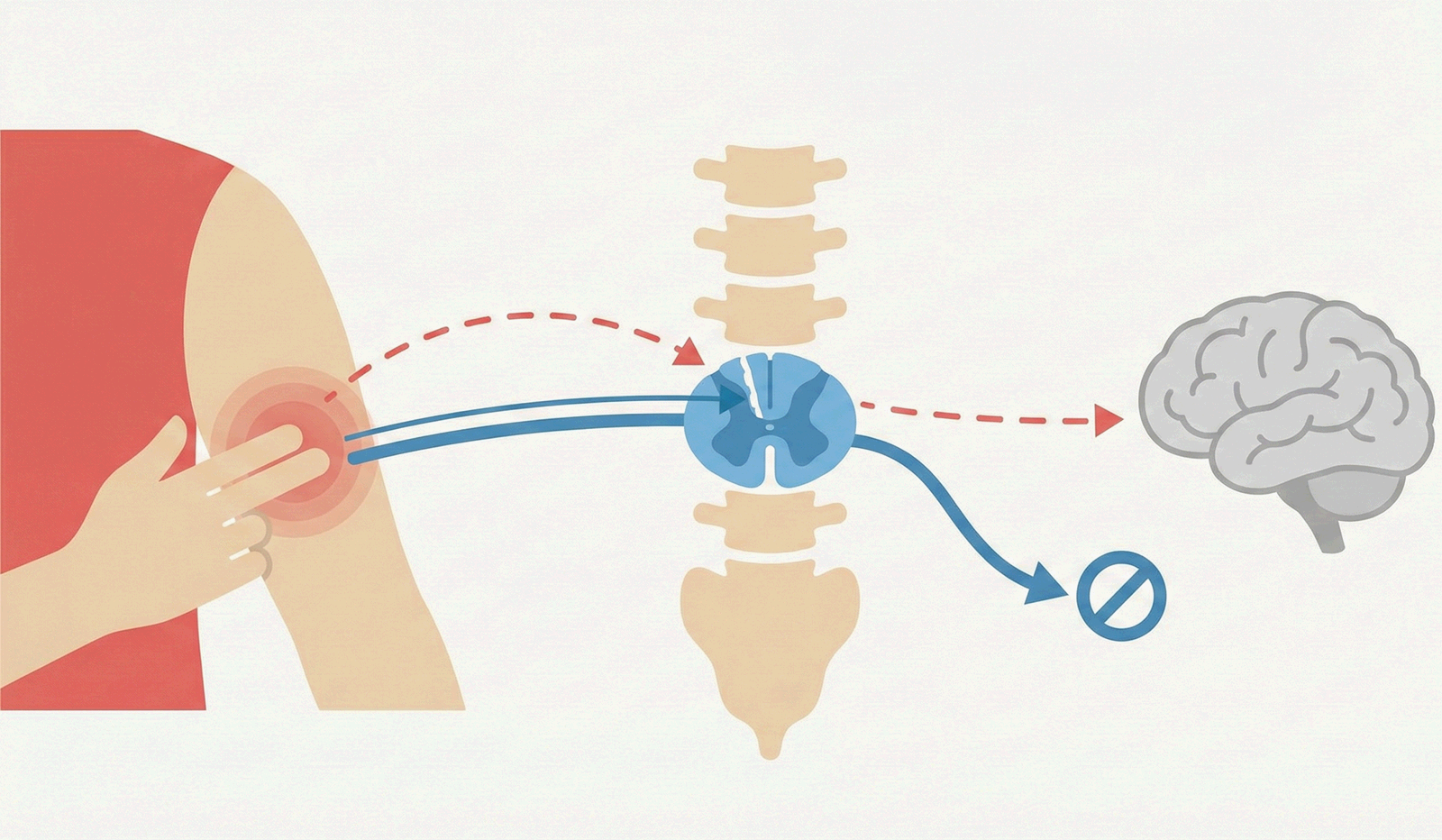 통증 조절, 관문 조절설 이론(신경 메커니즘, 억제 효과) 일러스트레이션