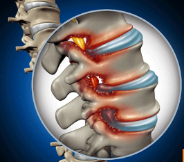척추관협착증 초기증상 7가지, 지나가기 쉬운 위험신호 총정리