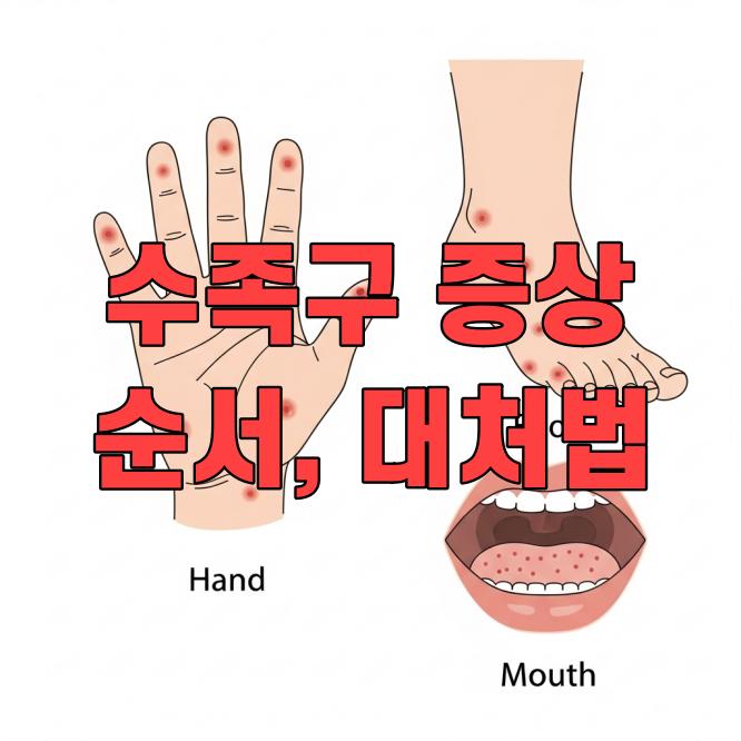 수족구 증상 순서, 진행단계와 대처법 총정리