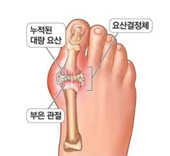 발가락 통풍 증상 및 대처방법_1