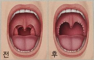 코골이