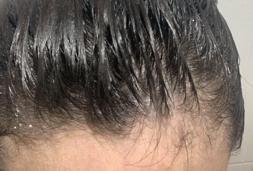 탈모원인과 예방법