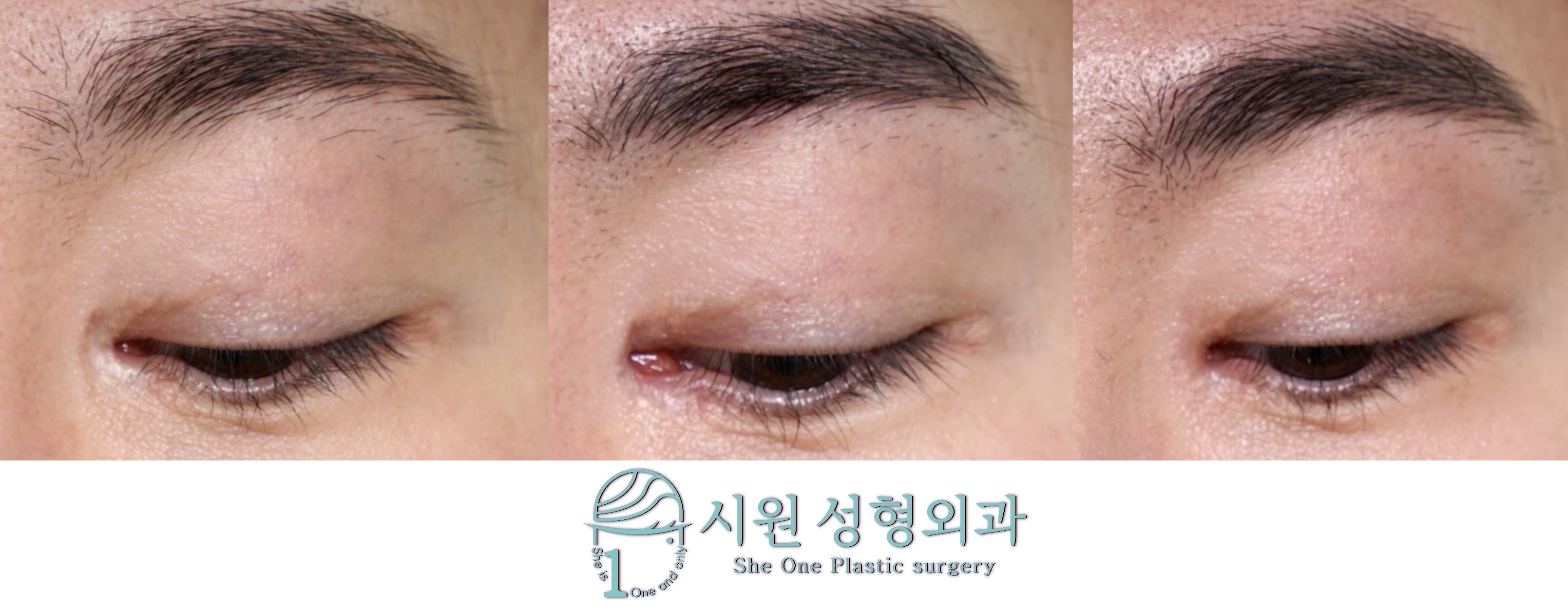 2-Month Results of Staged Epicanthoplasty Scar Revision (before - after 1st stage - after 2nd stage)