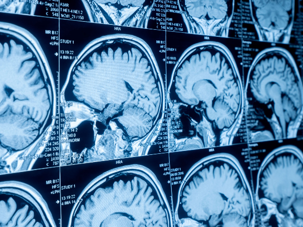 뇌 MRI