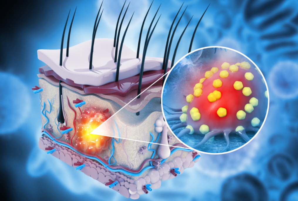 피부암 초기증상