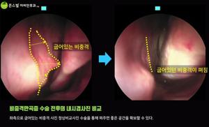 강남비중격만곡증