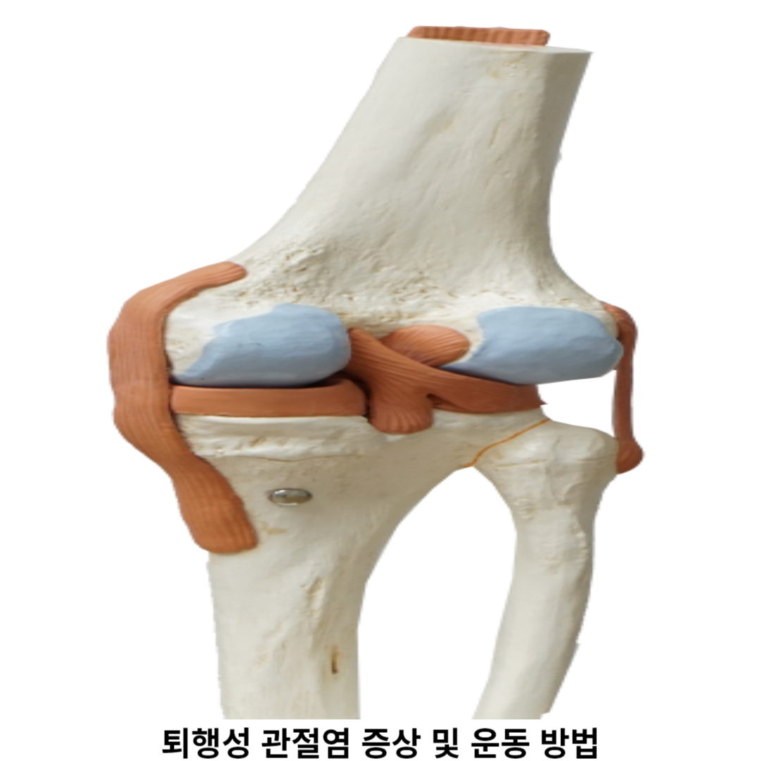 퇴행성 관절염 관리 위한 운동